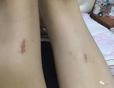 目前的现状,伤口处留下伤疤。