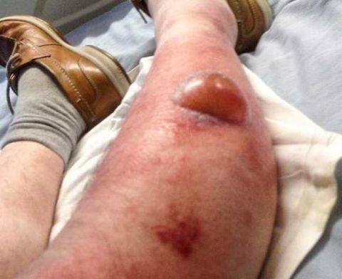 55岁男子在被蜘蛛咬伤后腿部严重感染并渗出水泡