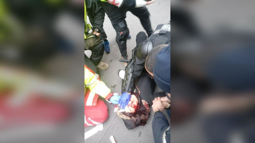 里格涅尔眼睛被击中后,她的男朋友拍下了这张照片