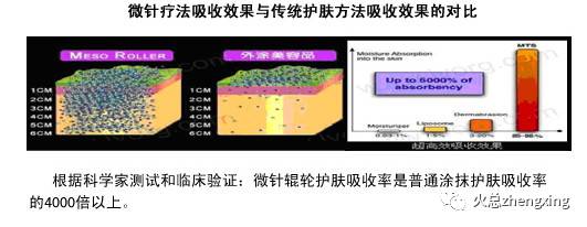 微针治疗