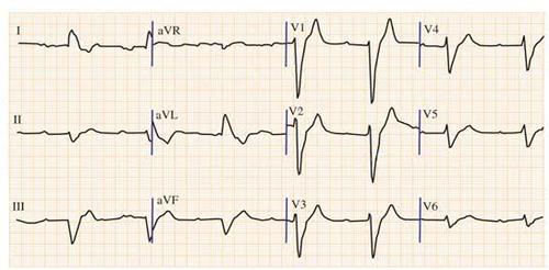 血钾异常的心电图表现,最经典的在这里