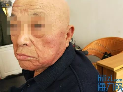 (老人两侧脸颊有明显红肿。)