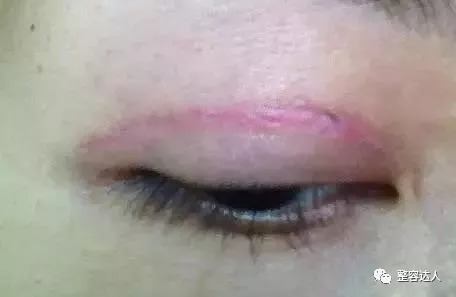 双眼皮