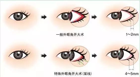 为什么做开眼角手术 哪种情况做开眼角手术