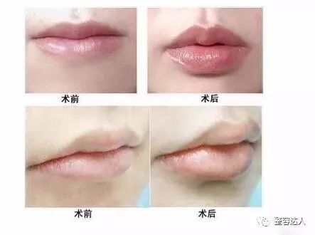 疗程和恢复