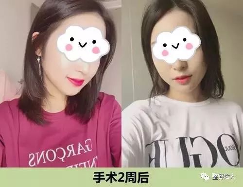 术后两周