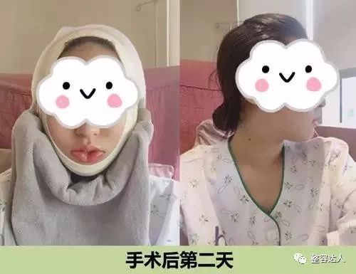 术后第二天