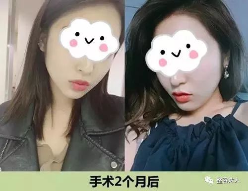 术后两个月