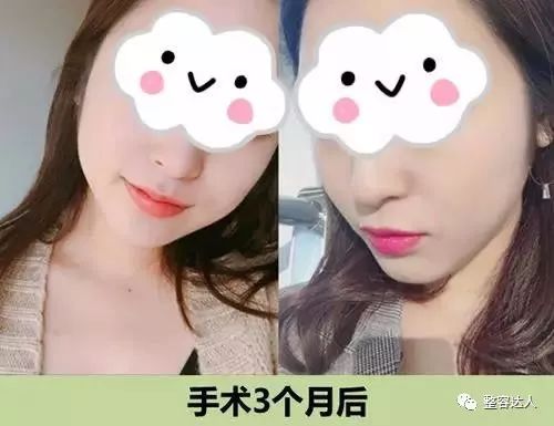 术后三个月