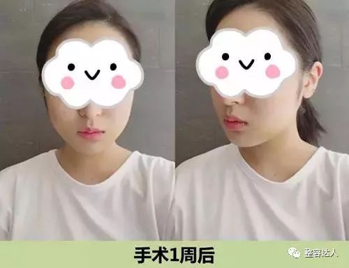 术后一周