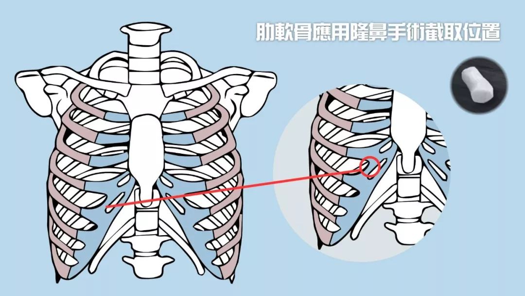 肋软骨