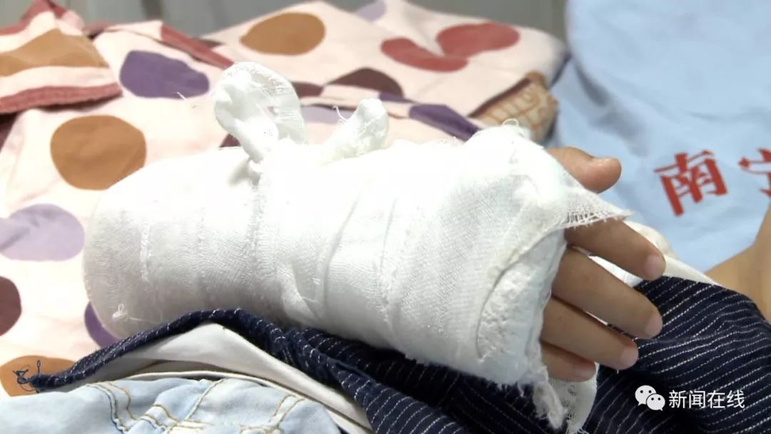 在万达茂玩蹦蹦床,六岁男孩右手臂被踩骨折脱