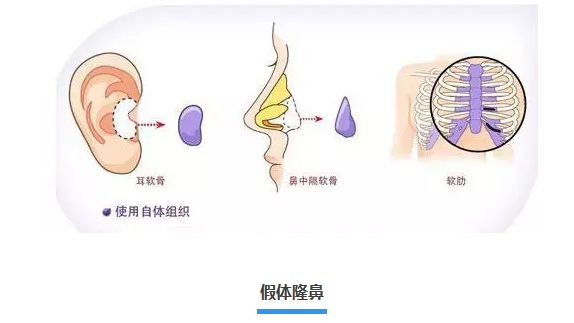 假体隆鼻