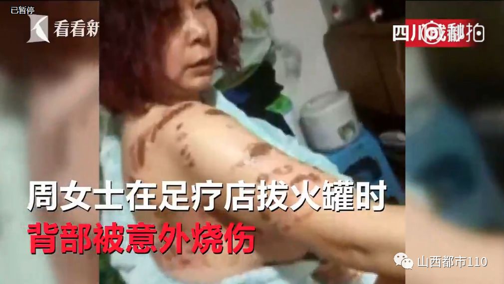 女子拔火罐"引火上身",背部二度烧伤满是疤痕……(视频)