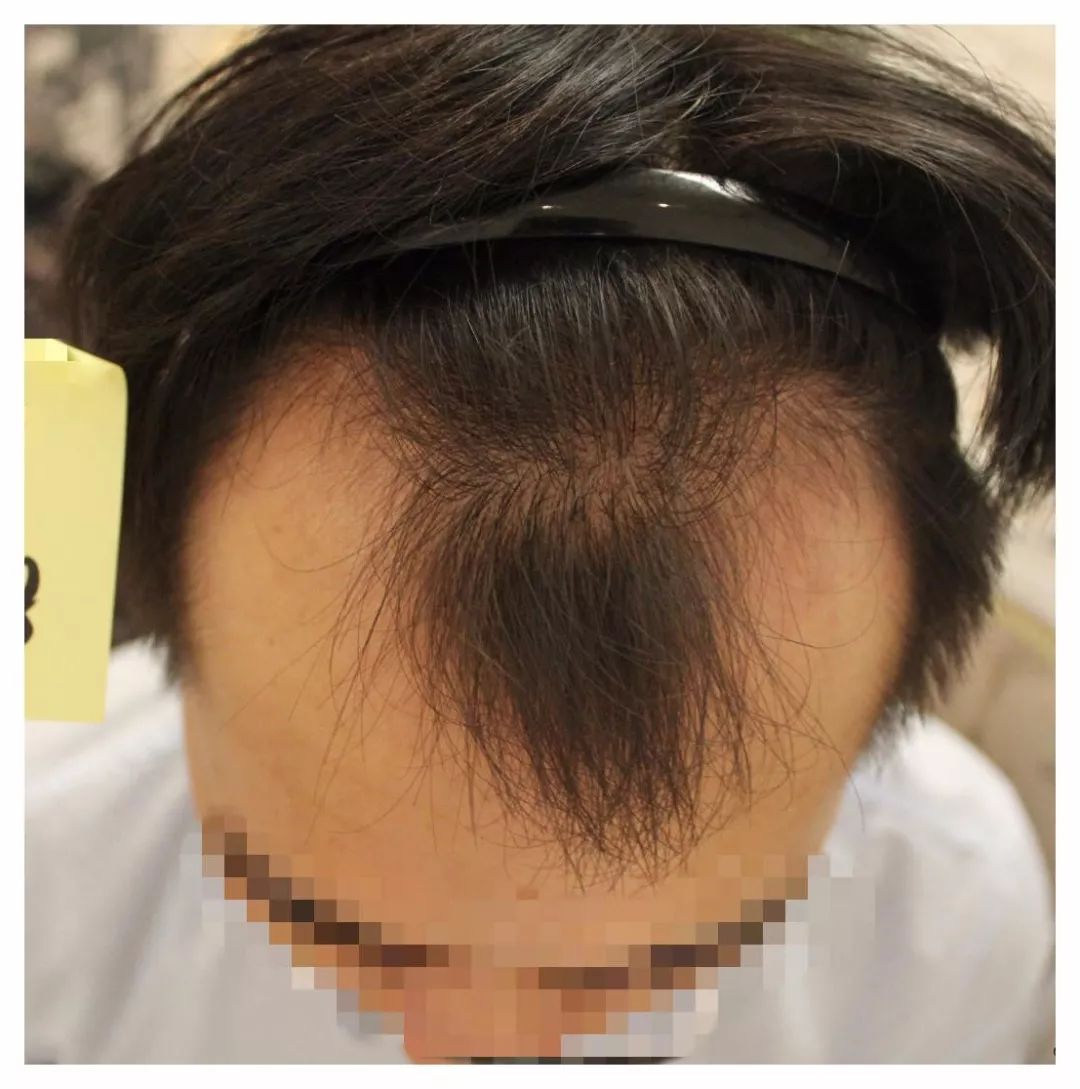 怎么治疗脱发和掉发（每天都脱发会变秃吗？面对脱发，应果断使出这些"招数"） | 说明书网