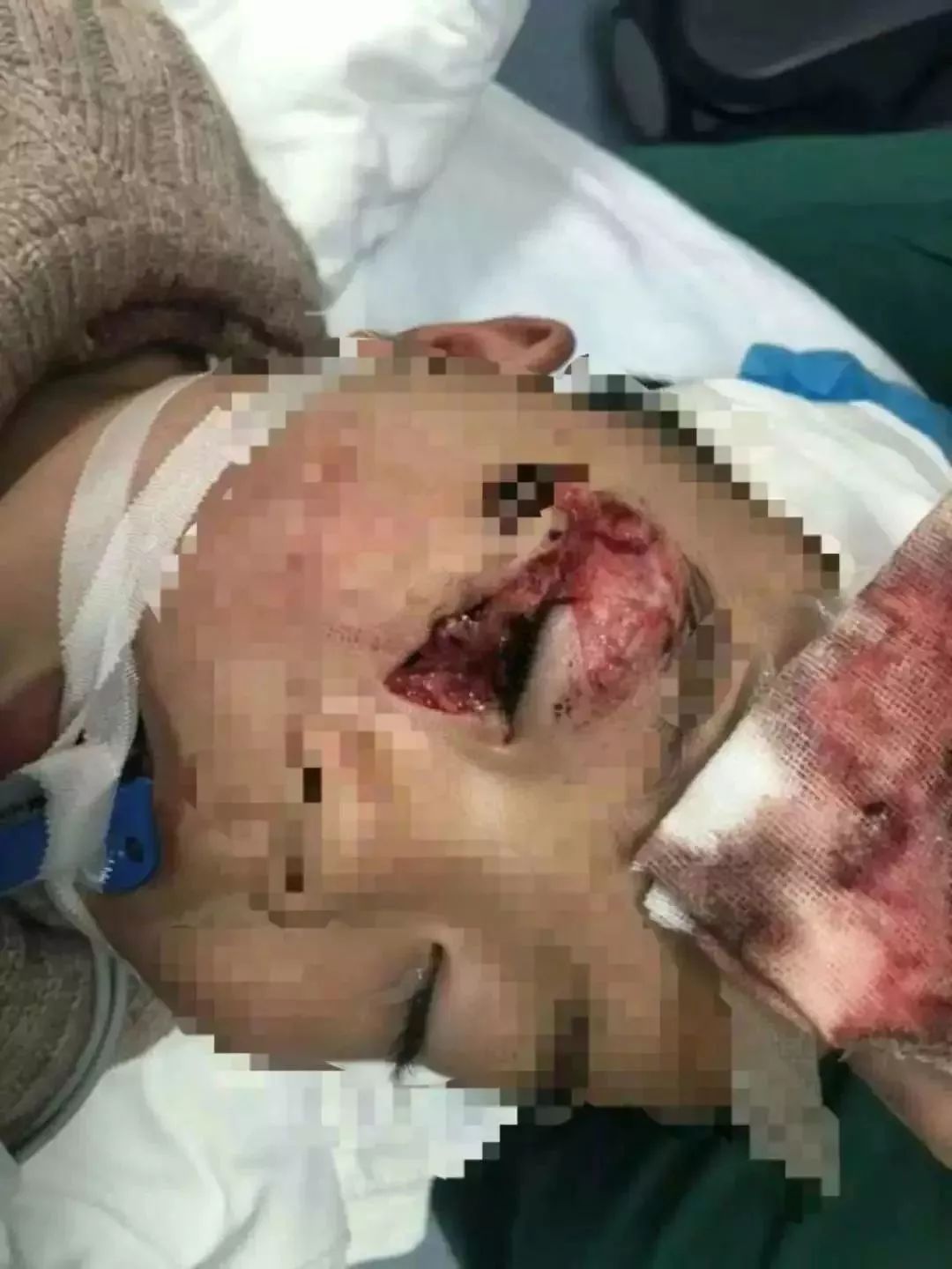 可怕!厦门3岁男童右眼被炸!缝100多针! 凶手 满