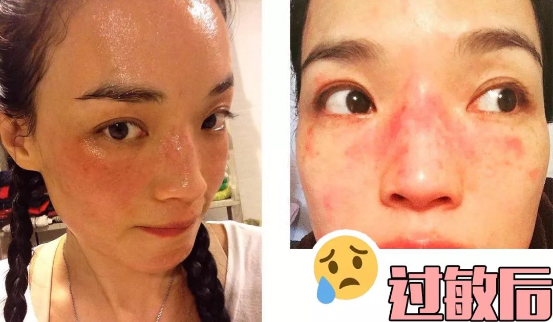 【尖货】吴昕脸肿到老了10岁!过敏肌,我们分手吧!