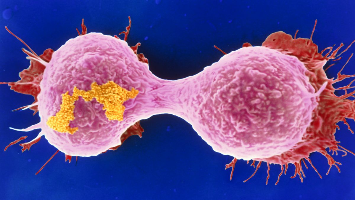 可怕!12岁小学生竟被查出癌症晚期!这些习惯年轻人必须要改了|癌症|死亡病例|国际癌症_新浪新闻