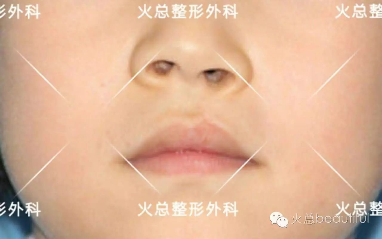 应用二维超声联合三维超声自由解剖成像技术诊断胎儿唇腭裂的体会