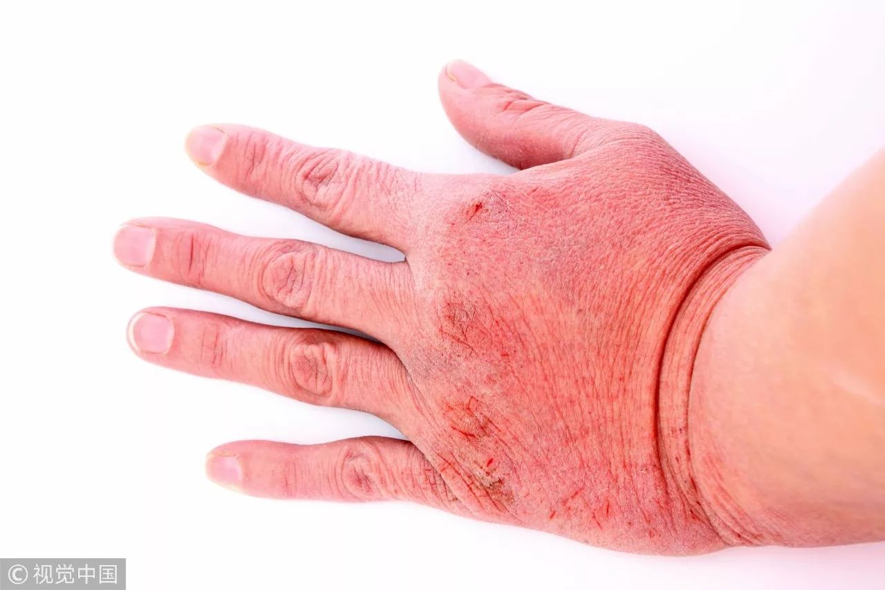 女子洗完澡皮肤如鱼鳞!医生提醒:冬天洗澡别做