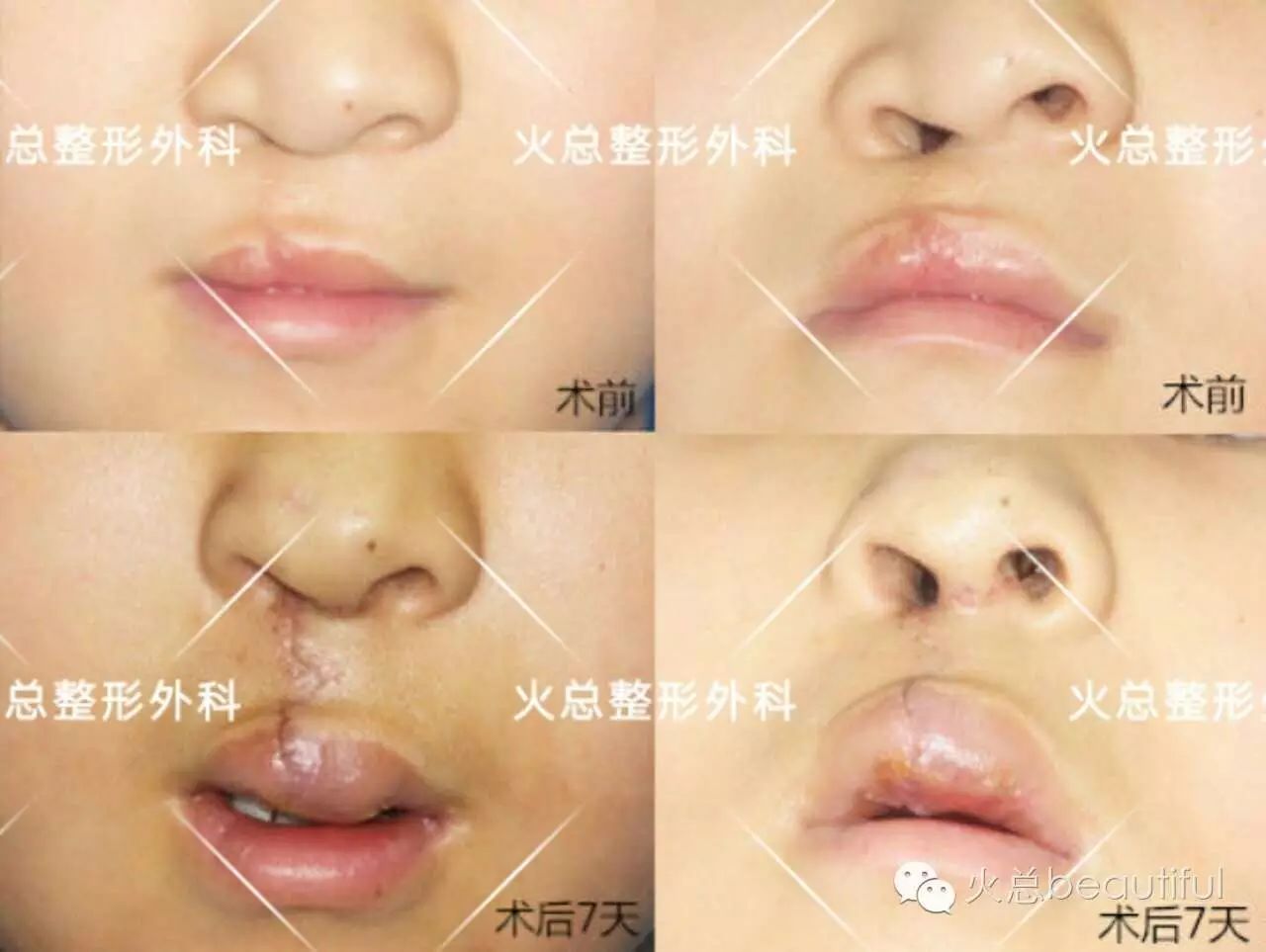 3-6个月   2,学龄前修复:6-7岁   3,成人后修复:18-20岁   三单侧唇裂