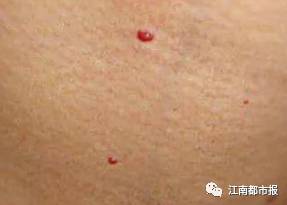 【健康】身上突然长这种小红点,千万别大意!看