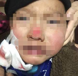 3岁男孩撞碎镜子削掉落鼻头