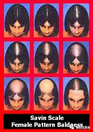 女性脫髮評級，圖自hairtransplantmentor.com