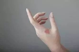 几块钱的红霉素眼膏,功能强大到让你怀疑人生