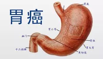胃癌