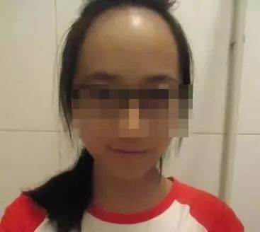 全城征集脱发、秃顶等毛发缺失者，享免费治疗 | 最后2个免费名额!|植发|手术|杨光_新浪新闻