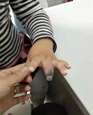 2岁小女孩划破手指，妈妈这样包扎，结果要截肢！（组图） - 9