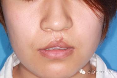 让微笑弥补缺憾唇裂术后的修复