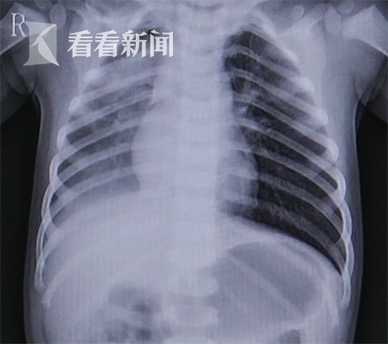 视频|1岁半男童开心果吸入肺部致咳血 家属以为