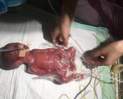 山西最小早产儿康复这个手掌婴儿出生时仅790克胎龄只有6个月