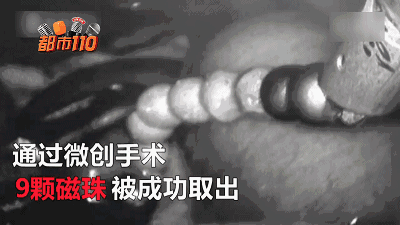 两岁男童误食磁力珠?! 肠道被穿六个洞……(视频)|男童|肠道|珠子_新浪新闻