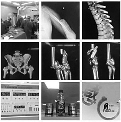 林刚发的朋友圈里，影像照片显示孩子骨折非常严重。 院方供图