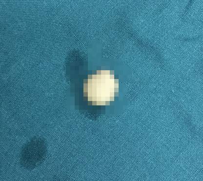 被切掉落的鼻头