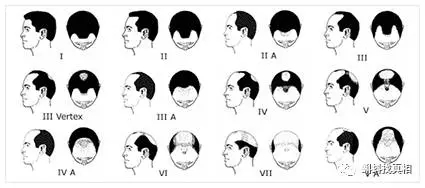  男性脫髮評級，圖自hairtransplantmentor.com