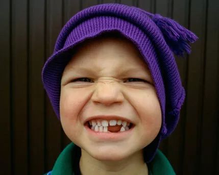 济南5岁男孩满口乳牙全部烂掉,疼得吃不下饭!