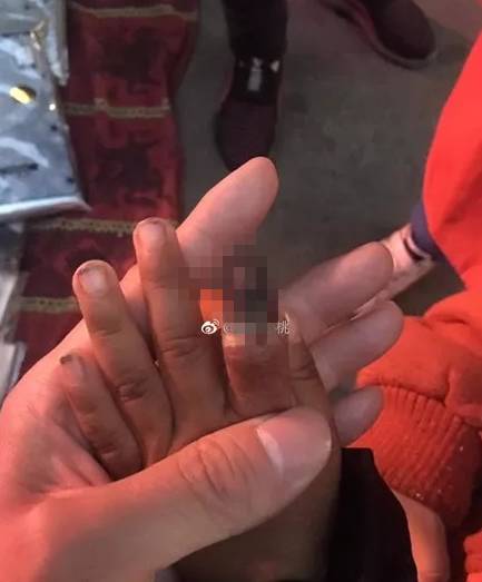 2岁小女孩划破手指，妈妈这样包扎，结果要截肢！（组图） - 2