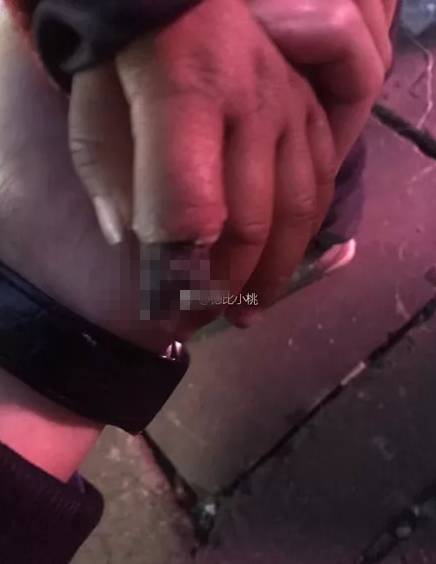 2岁小女孩划破手指，妈妈这样包扎，结果要截肢！（组图） - 3