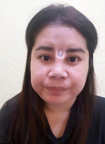 惊恐!泰女子隆鼻失败两眼间外露一截硅胶棒