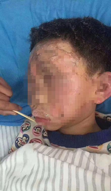 重庆警方:男童疑因喝止偷车贼被泼油烧伤情况
