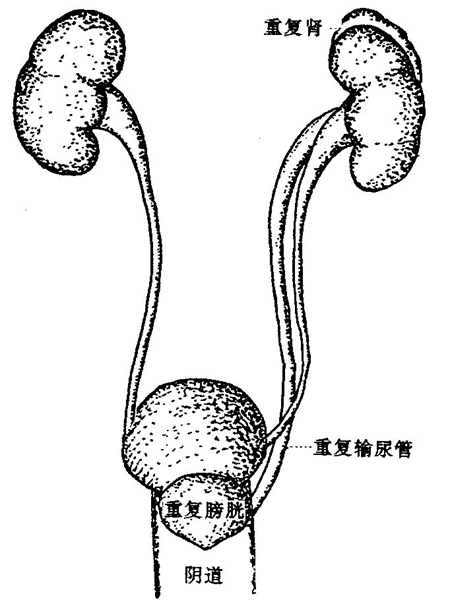 原因:多长了一个肾脏 泌尿外科丁留成医生接诊了汤大妈,通过初步的