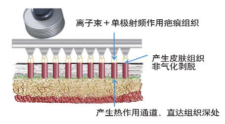 点阵激光