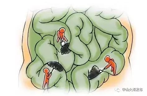 怎么样才能快速排宿便 YIXV-fypikwu0390984.jpg