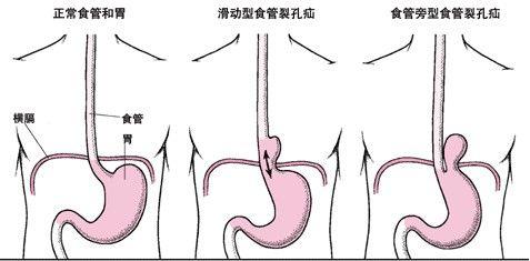 多喝热水？这可能会增加人体罹患食管癌的风险！