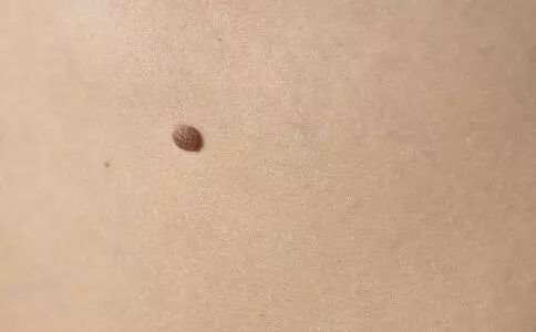 昆明女子去美容院点痣，最后竟然成了皮肤癌！