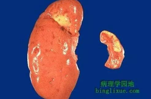(肾脏萎缩图示)